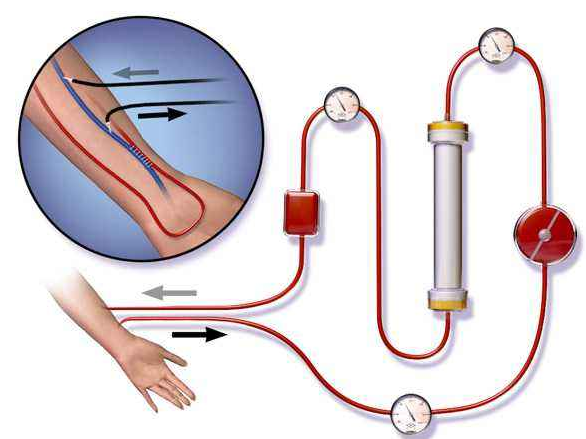 血液透析器端蓋專用塑料，你找對生產(chǎn)廠家了嗎？